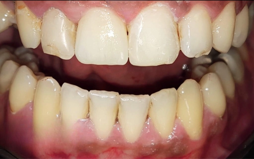 Avant traitement soins dentaires BioDental Annaba